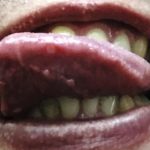 口内炎が舌の先にできる原因と薬や治療法について