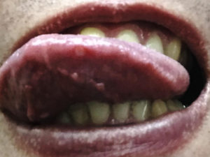 口内炎が舌の先にできる原因と薬や治療法について